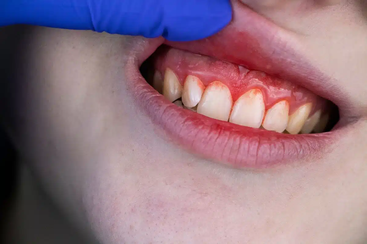 Painful gum irritation from whitening